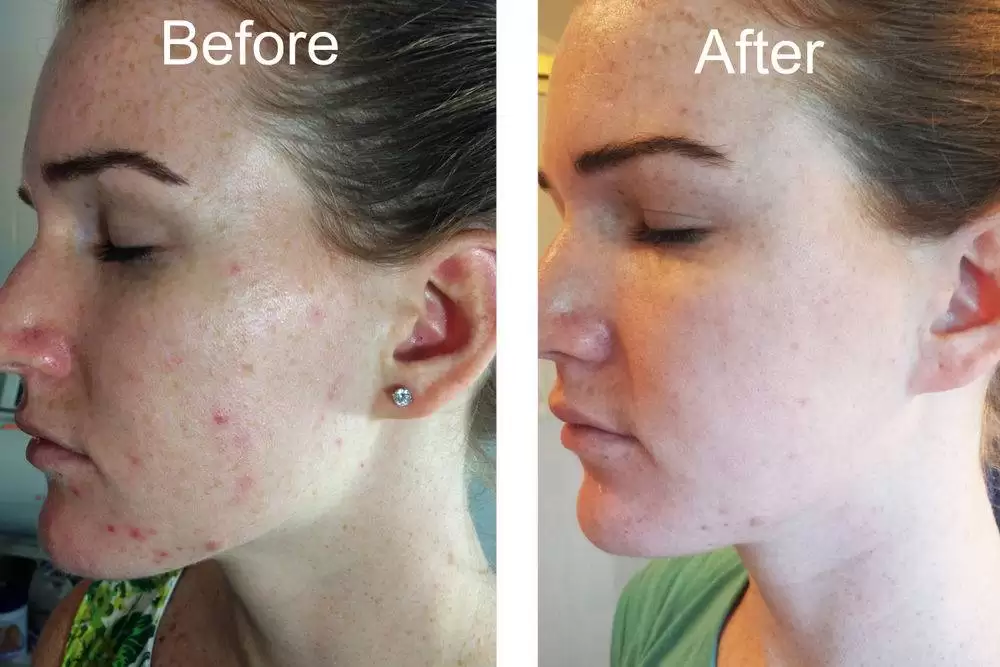 راز جوان سازی پوست با هیدرودرم