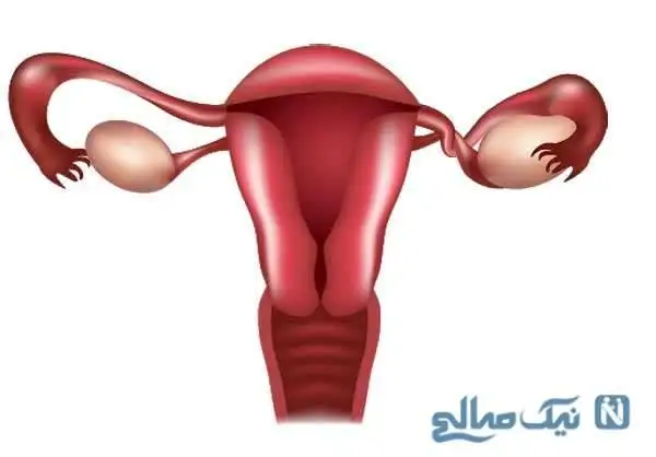پیچ خوردگی تخمدان در زنان و دختران ؛ پیچ خوردگی تخمدان چه علائمی دارد ؟ راههای درمان