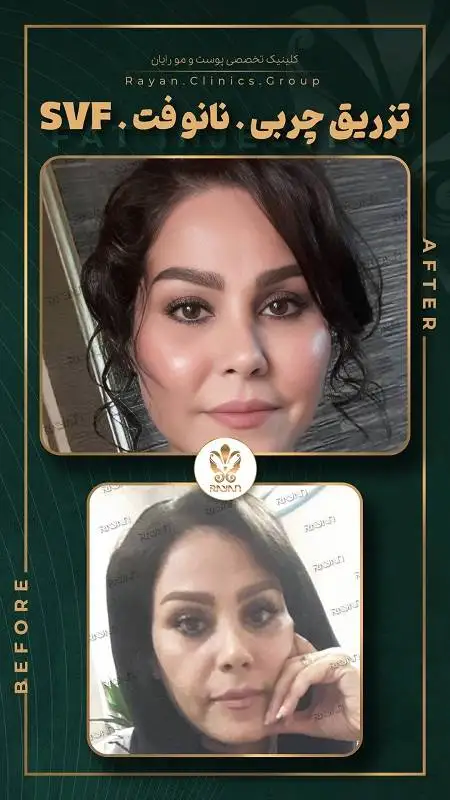 جدیدترین روش های تزریق چربی 1404