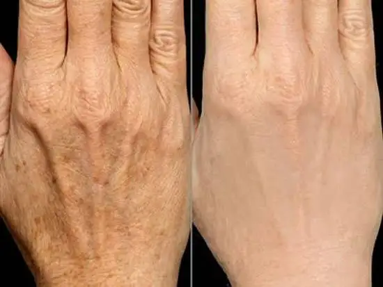 جدیدترین روش های تزریق چربی 1404