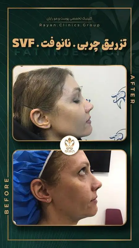 جدیدترین روش های تزریق چربی 1404