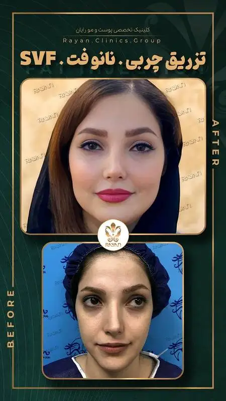 جدیدترین روش های تزریق چربی 1404