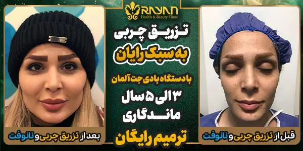 جدیدترین روش های تزریق چربی 1404