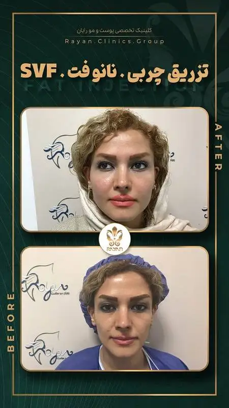 جدیدترین روش های تزریق چربی 1404