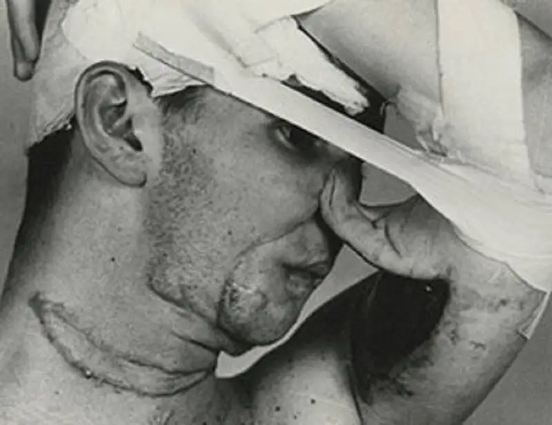 تصاویر؛ سفر در زمان؛ تاریخچه عمل های زیبایی؛ استفاده از پوست پیشانی برای ترمیم بینی های قطع شده در مجازات ها