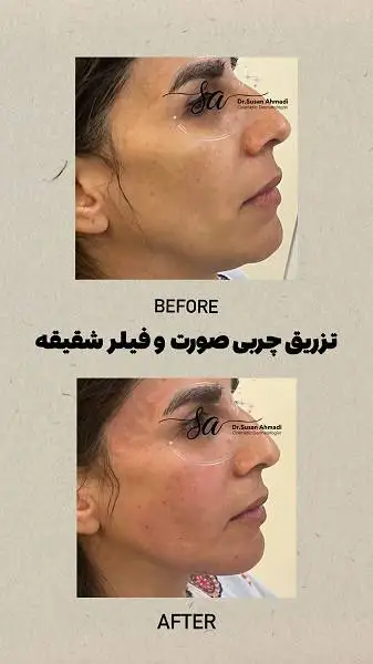 تزریق چربی به صورت چقدر ماندگاری دارد؟