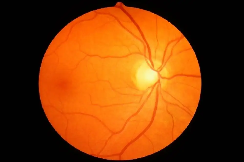 اگر می خواهید لاغر شوید مراقب بینایی خود باشید