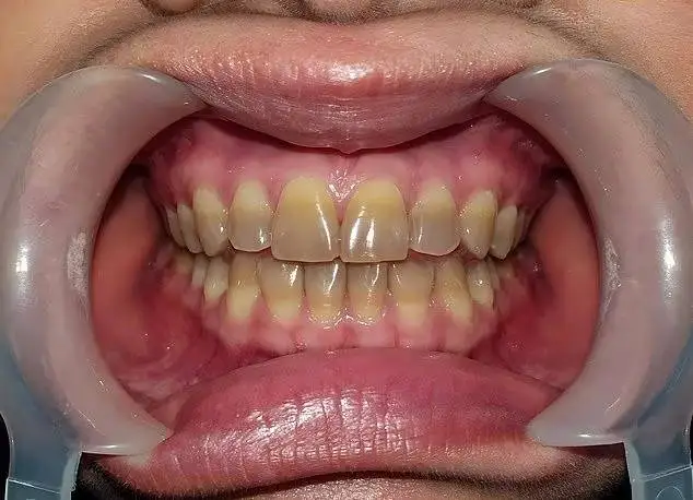 تصاویر؛ رنگ دندان از دیدگاه علم چه چیزهایی درباره سلامت شما می گوید؟