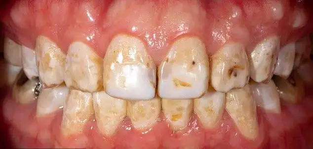 تصاویر؛ رنگ دندان از دیدگاه علم چه چیزهایی درباره سلامت شما می گوید؟