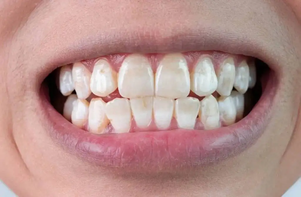 تصاویر؛ رنگ دندان از دیدگاه علم چه چیزهایی درباره سلامت شما می گوید؟