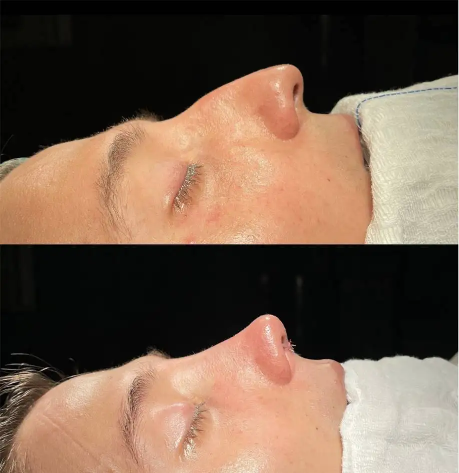 همه چیز درباره جراحی بینی که باید بدانید