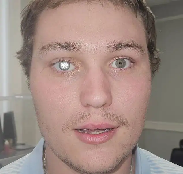 تصاویر| چشم مصنوعی با الماس 2 قیراطی مردی که شبیه شرورهای جیمز باند است!