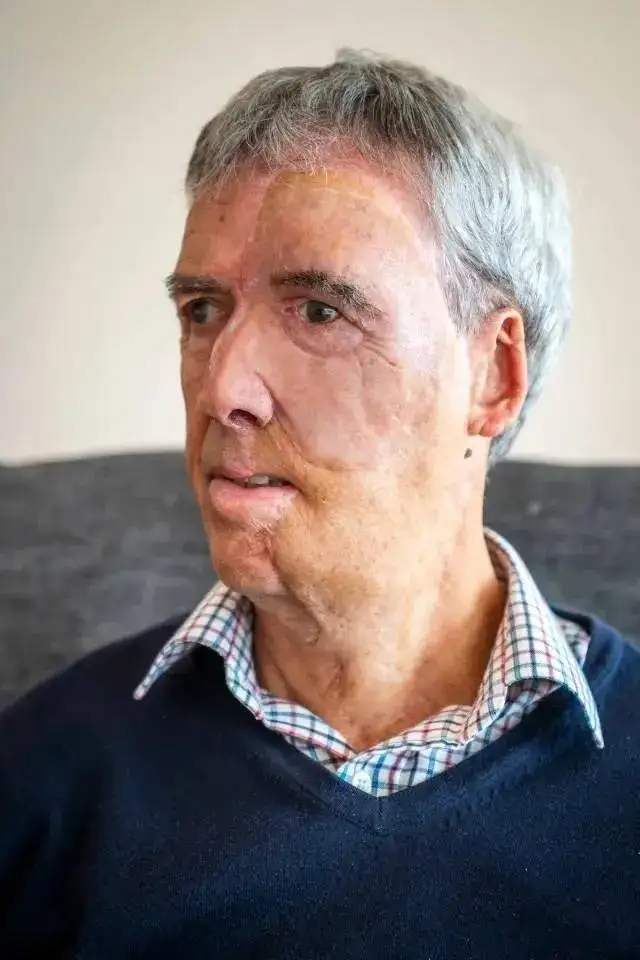 تصاویر؛ بازسازی شگفت انگیز چهره یک دوچرخه سوار پس از تصادف دلخراش