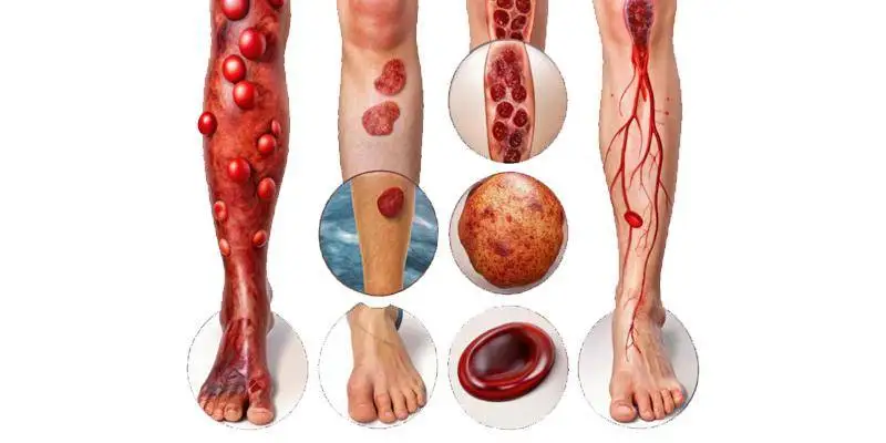 لخته شدن خون در پا چه خطراتی دارد؟ از عوارض مزمن تا مرگ ناگهانی