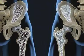 این ویتامین های مهم از پوکی استخوان شما جلوگیری می کنند
