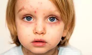 همه چیز در مورد یک ویروس بهاری؛ بیشتر مراقب کودکان خود باشید
