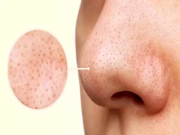 بهترین و بدترین روش  از بین بردن جوش  سرسیاه