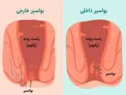 خونریزی  مقعدی 