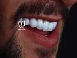 اهمیت انتخاب برند مناسب برای کامپوزیت  دندان