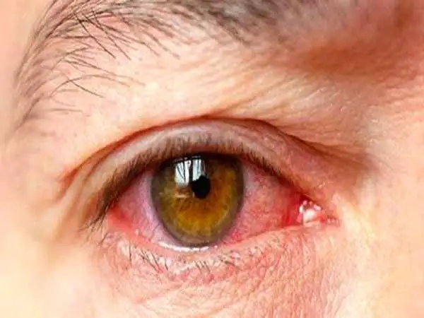 چه غذاها و نوشیدنی هایی فشار چشم را بالا می برد؟