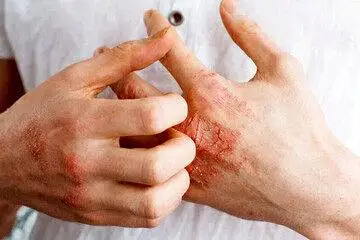 دلیل مهم اگزما در پوست