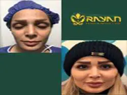 جدیدترین روش های تزریق چربی 1404