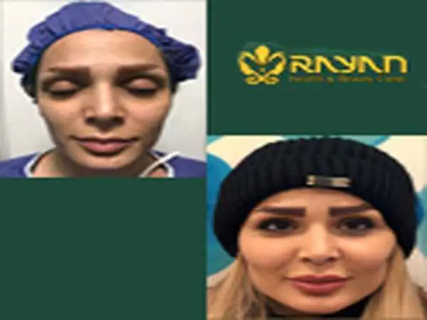 جدیدترین روش های تزریق چربی 1404