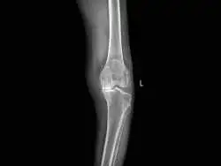 تغییر «شیوۀ راه رفتن» می تواند پیشرفت «بیماری آرتروز» را به تعویق بیاندازد