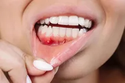 جایگزین طبیعی آنتی بیوتیک برای درمان بیماری لثه
