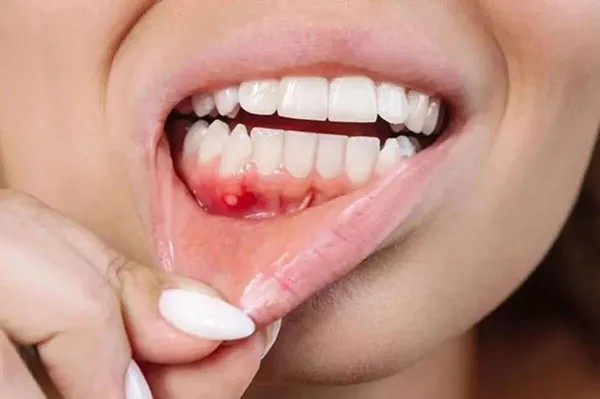 جایگزین طبیعی آنتی بیوتیک برای درمان بیماری لثه
