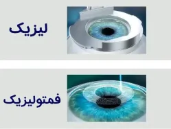خداحافظی با عینک با عمل فمتولیزیک توسط دکتر محمدخانی 