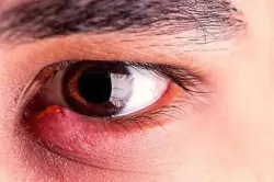 گل مژه؛ اشتباه ساده ای که برای چشم گران تمام می شود
