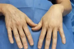 هزینه تزریق چربی به دست چقدر است؟